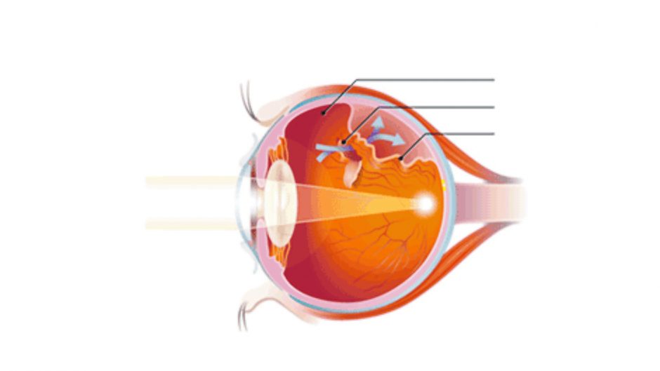 Žaibavimas akyse gali būti aklumu gresiančios ligos pranašas